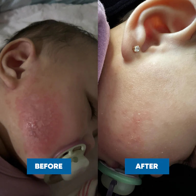 MooGoo Baby Eczema & Psoriasis Cream 120g